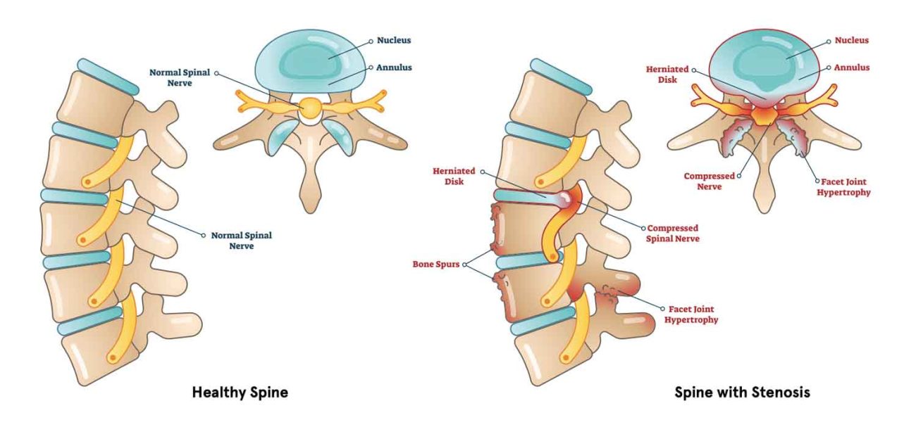 تفاوت دیسک کمر و تنگی کانال نخاعی - دکتر فرزین شیراز