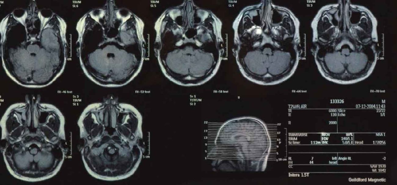 دیسک کمر و تنگی کانال نخاعی - دکتر نوید فرزین