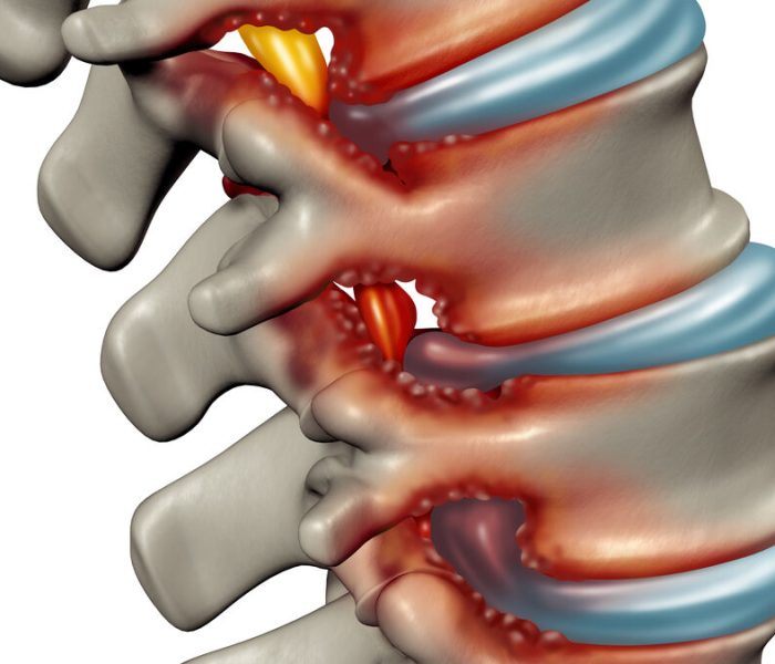 تفاوت دیسک کمر و تنگی کانال نخاعی - دکتر نوید فرزین