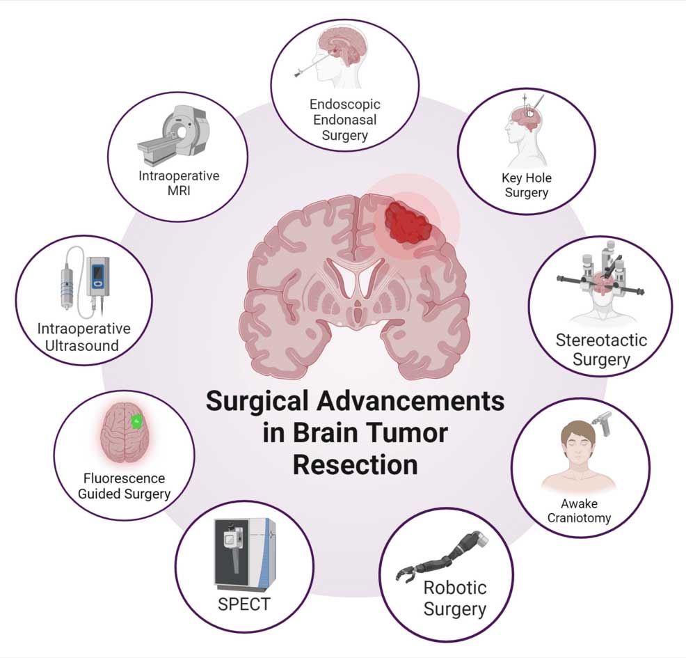 نکات مهم در تشخیص و درمان تومورهای مغزی - دکتر نوید فرزین