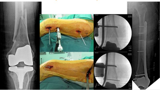 جراحی شکستگی و پوکی