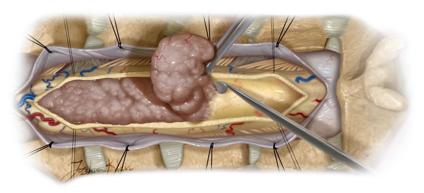جراحی تومور مغزی - دکتر نوید فرزین شیراز