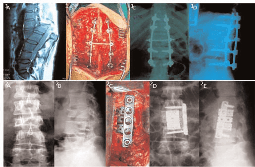 جراحی شکستگی و پوکی مهره ها - دکتر فرزین