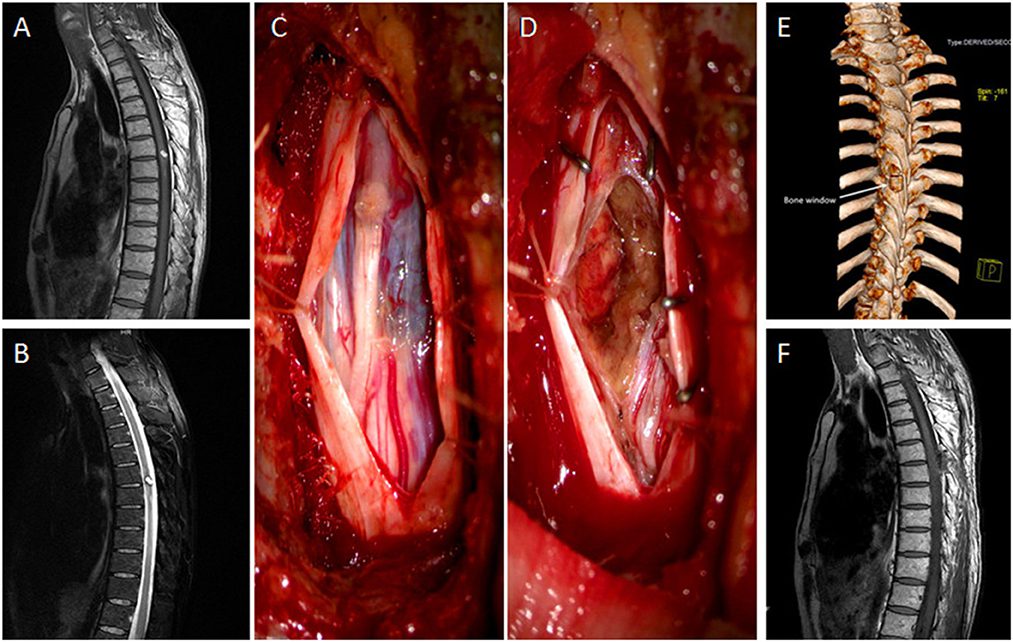 جراحی تومور مغزی - دکتر نوید فرزین