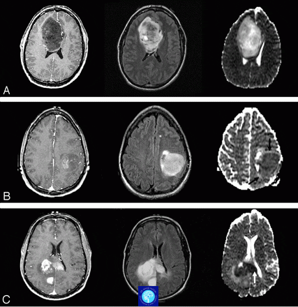 روش‌های جراحی تومور مغزی - MRI تومور مغزی