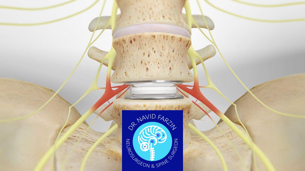 جراحی دیسک کمر در شیراز