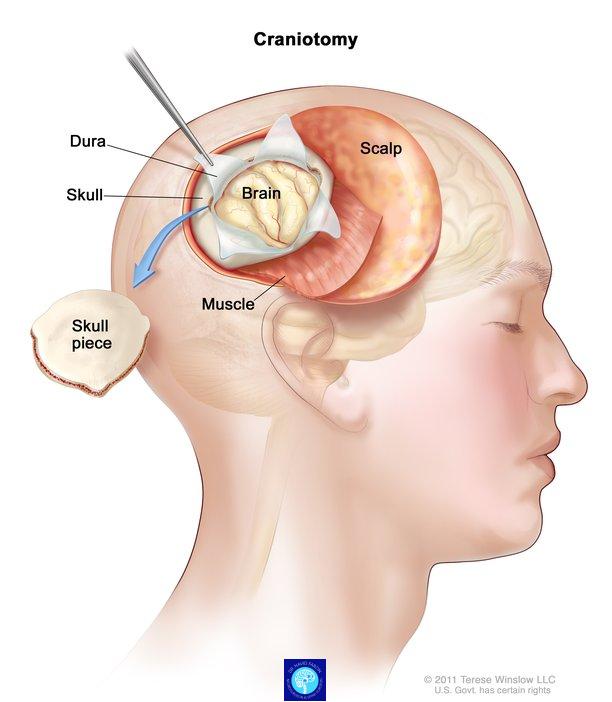 جراحی تومور مغزی شیراز - کرانیوتومی