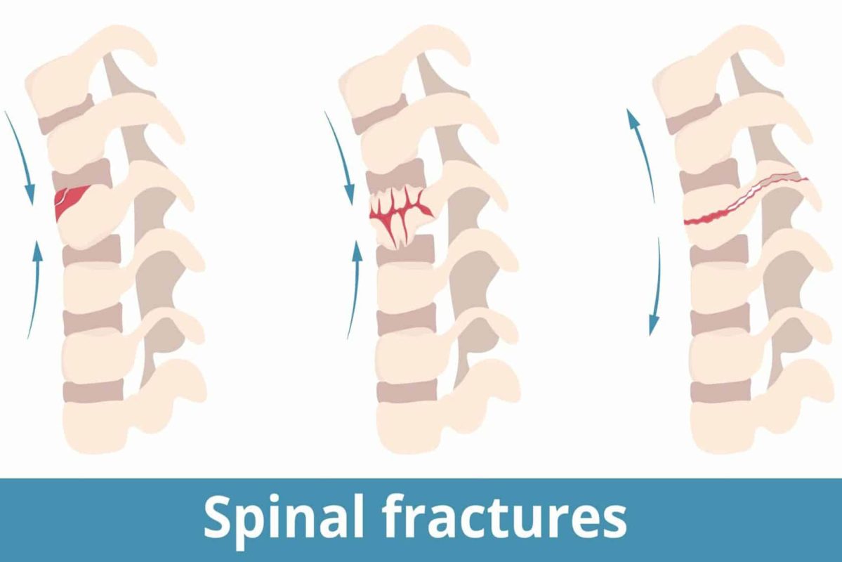 انواع شکستگی ستون فقرات