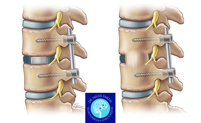 جراحی پلاتین‌گذاری ستون فقرات