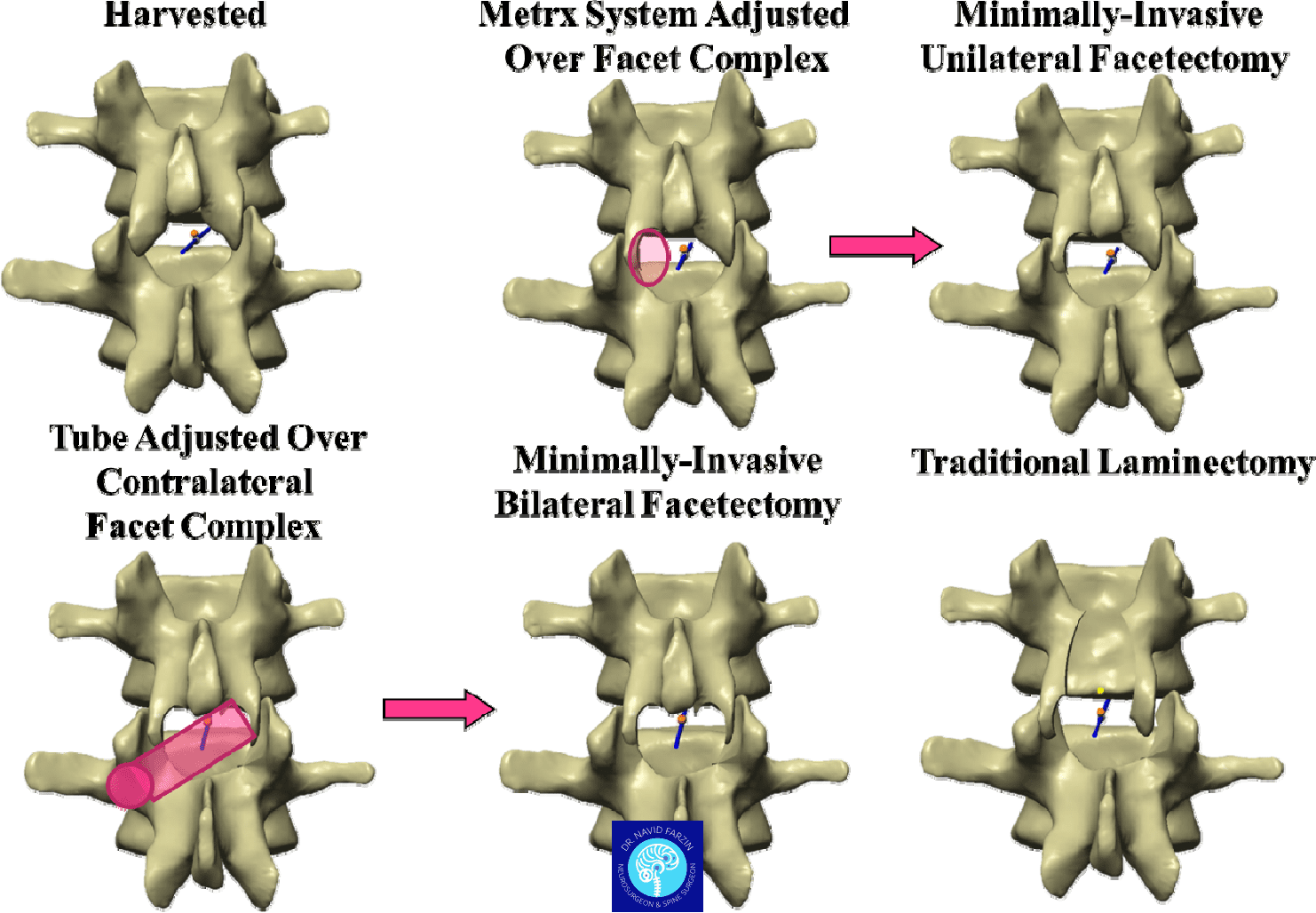 جراحی تنگی نخاع شیراز - لامینکتومی