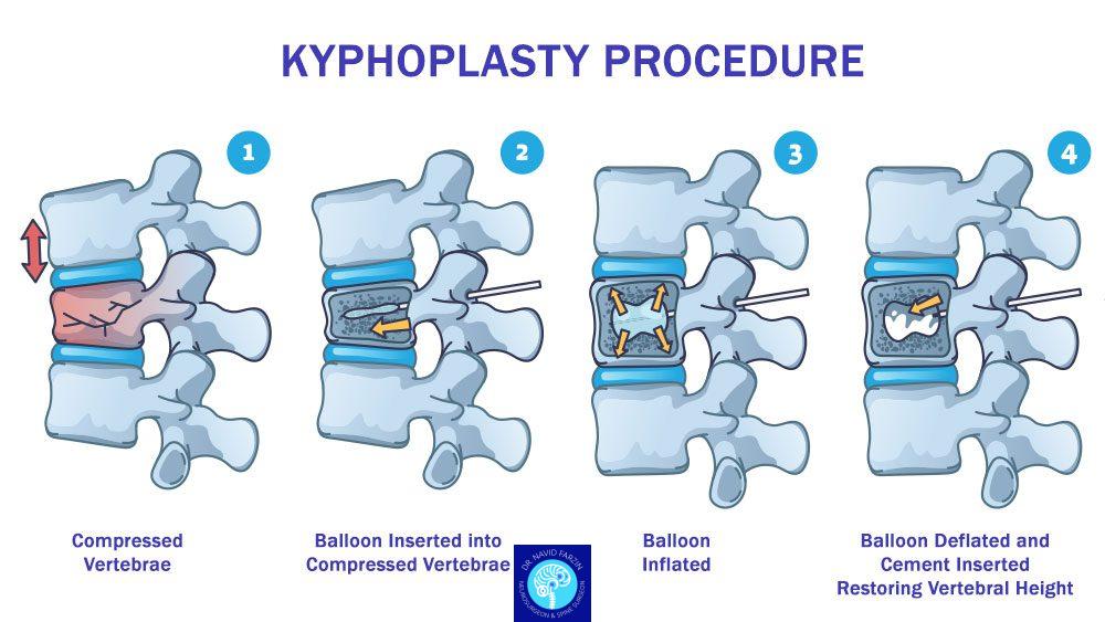 جراحی پوکی مهره‌ها - کیفوپلاستی