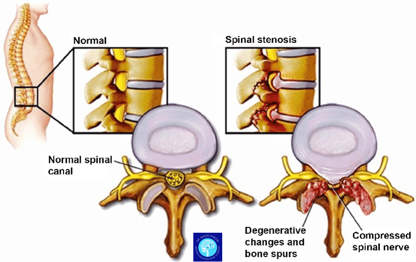 علائم تنگی کانال نخاعی - ساختار نخاع
