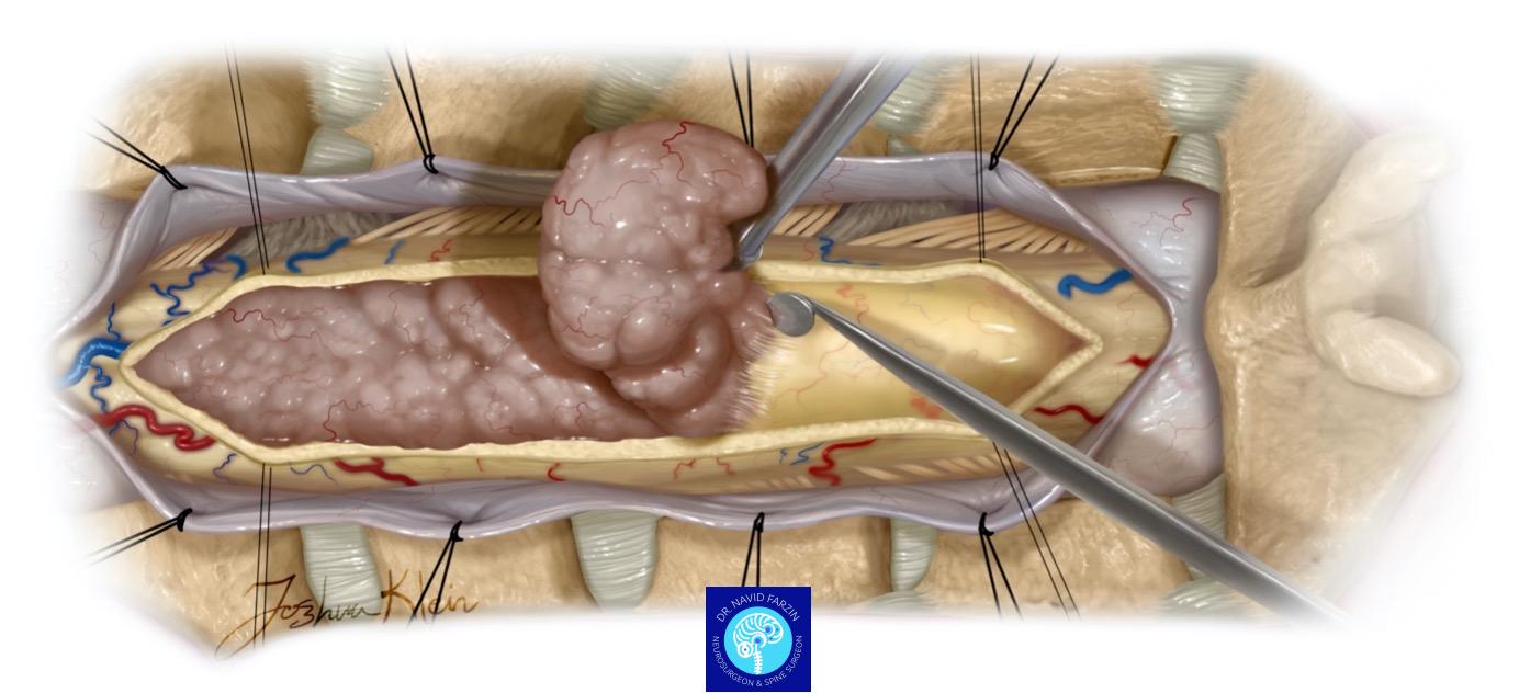 جراحی تومور نخاع شیراز - لامینکتومی