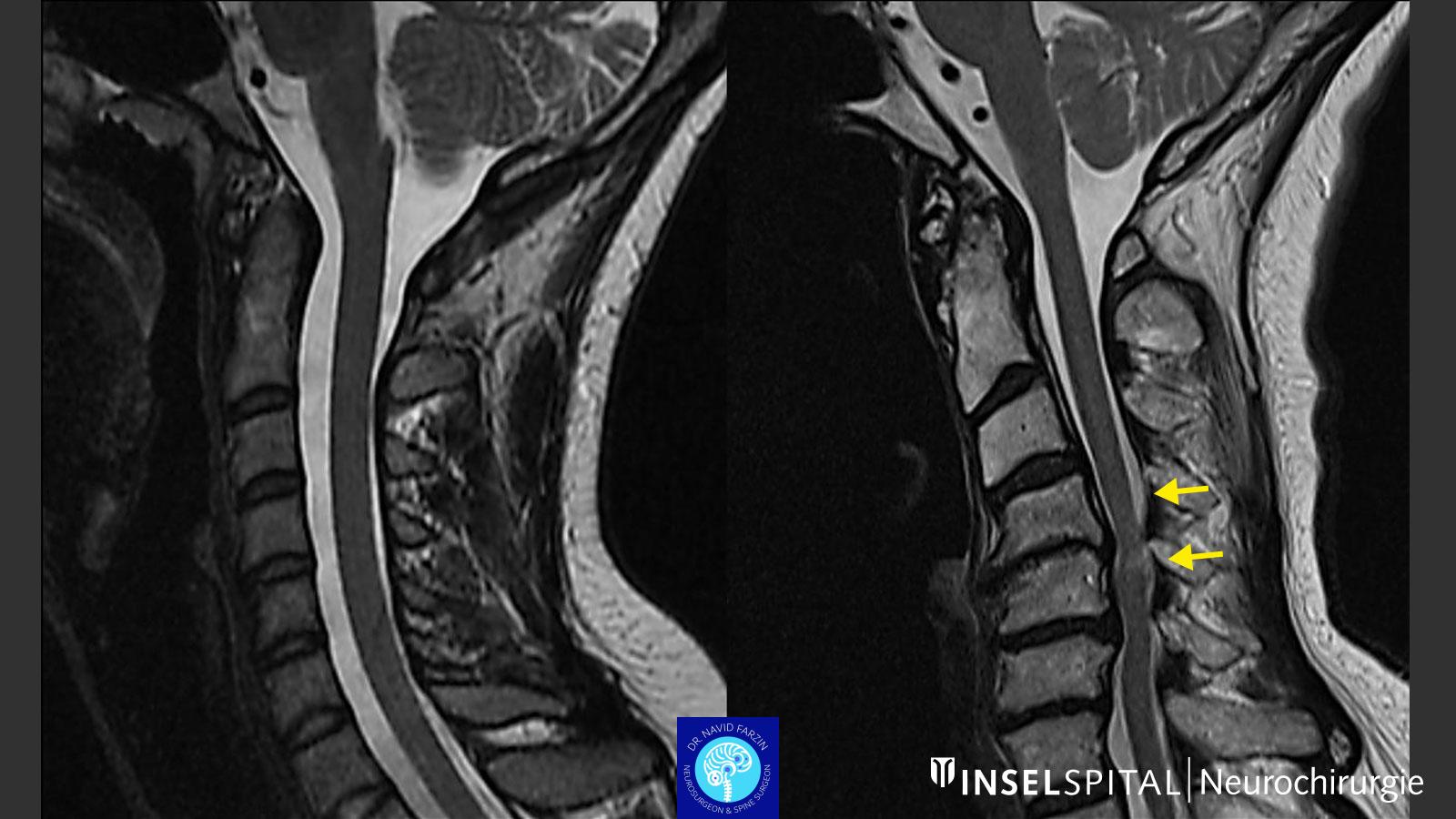 جراحی تنگی نخاع در شیراز - تصویر MRI