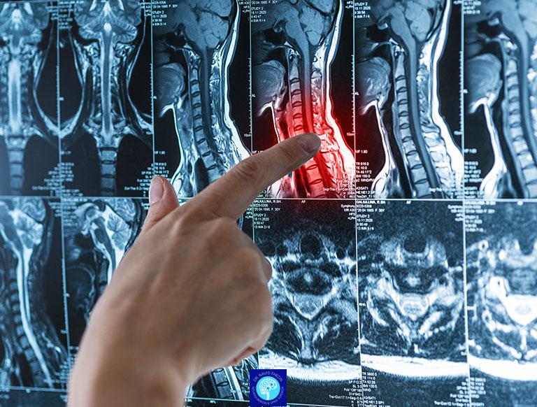 جراح تومور نخاع شیراز