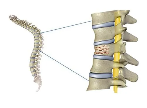 پیشگیری از شکستگی ستون فقرات