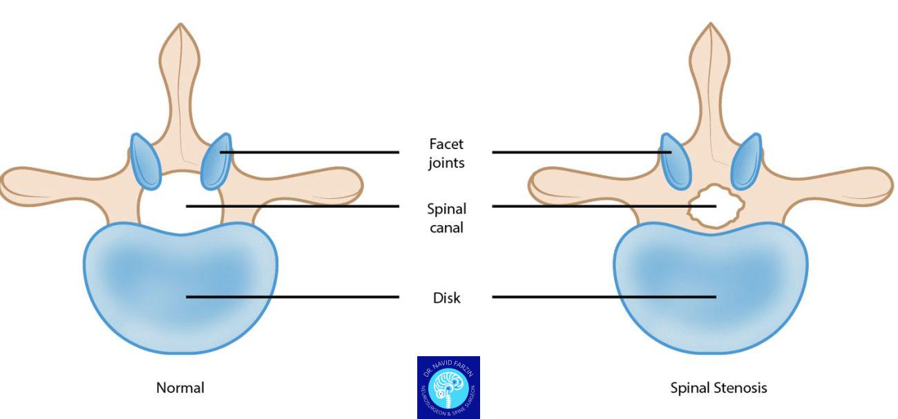 تفاوت دیسک کمر و تنگی نخاع