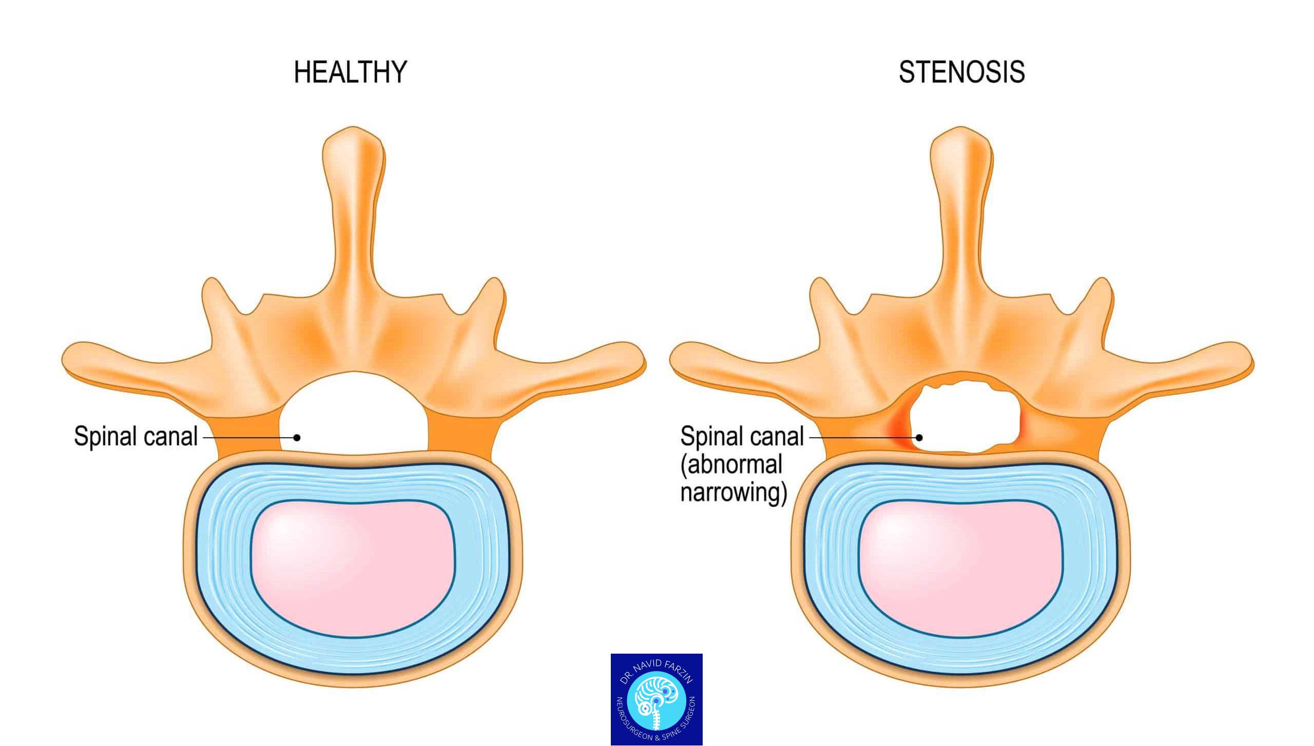 تفاوت دیسک کمر و تنگی نخاع: چگونه تشخیص دهیم؟