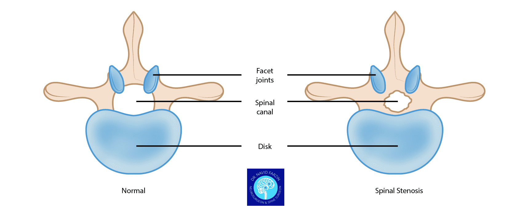روش‌های درمان دیسک کمر و تنگی نخاع