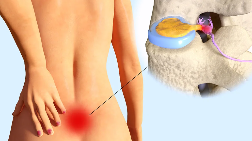 تفاوت دیسک کمر و تنگی نخاع