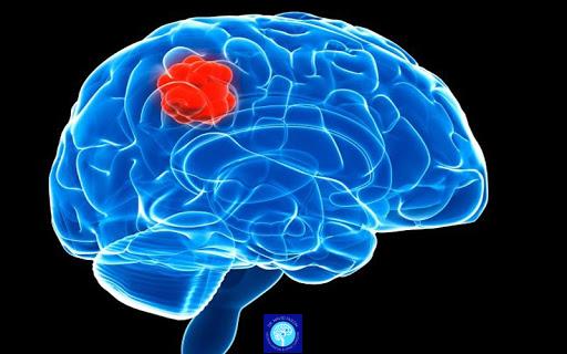 شایع‌ترین علائم اولیه تومور مغزی