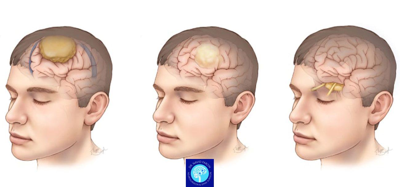 علائم اولیه تومور مغزی: چه زمانی باید به جراح مغز مراجعه کنیم؟ | راهنمای جامع