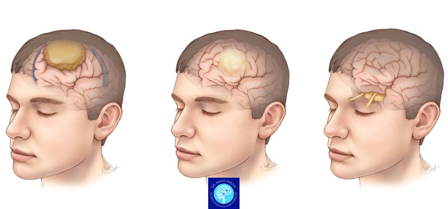 علائم اولیه تومور مغزی: چه زمانی باید به جراح مغز مراجعه کنیم؟ | راهنمای جامع