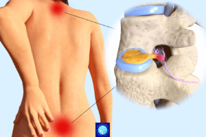 تفاوت درد سیاتیک با دیسک کمر