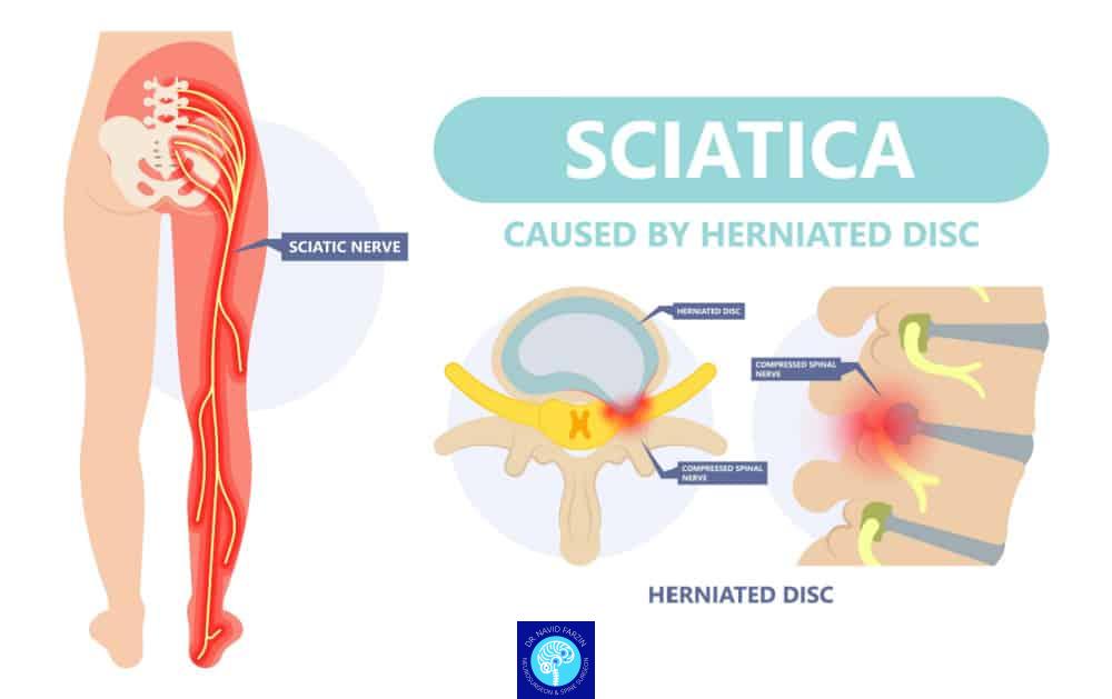 تفاوت درد سیاتیک با دیسک کمر چیست؟