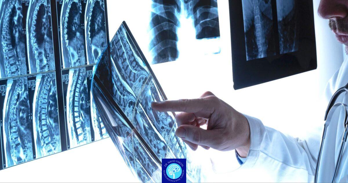 عوارض تاخیر در درمان تنگی کانال نخاعی