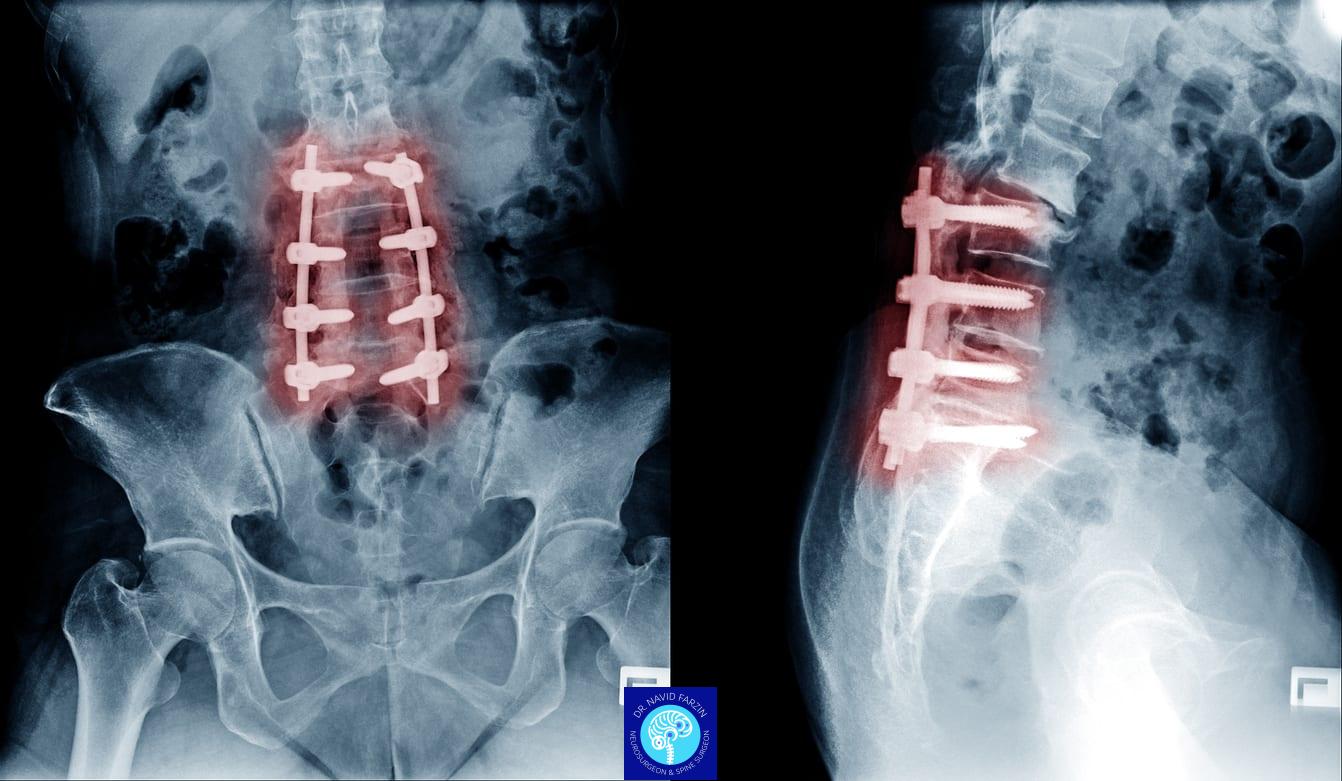 نقش MRI در تصمیم برای جراحی دیسک کمر چیست؟