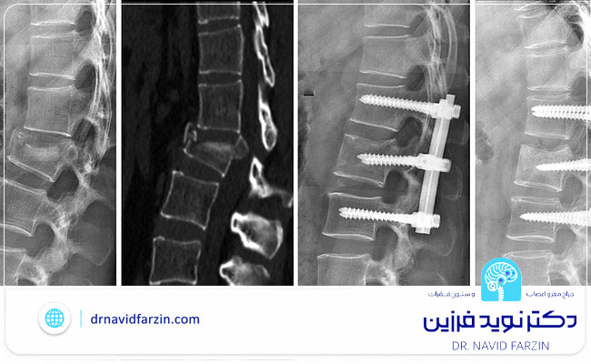جراحی شکستگی ستون فقرات در شیراز