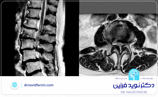 جراحی تنگی نخاع در شیراز