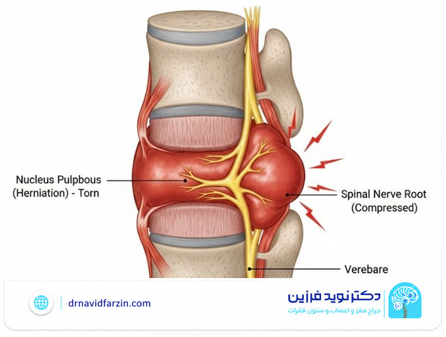دیسک کمر چیست؟