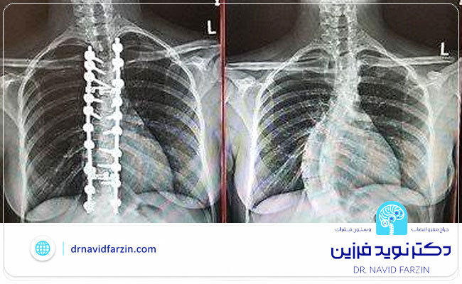 جراح ستون فقرات در شیراز