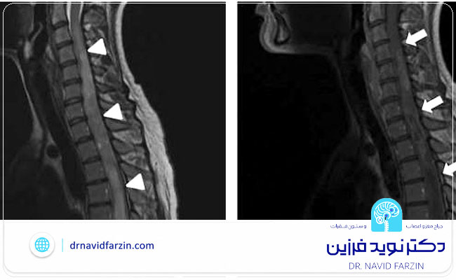 جراحی تومور نخاع در شیراز