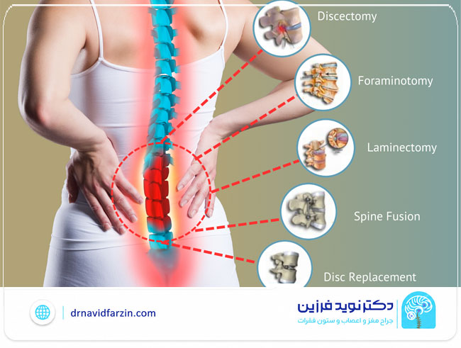 مزایا و ریسک‌های احتمالی جراحی دیسک کمر