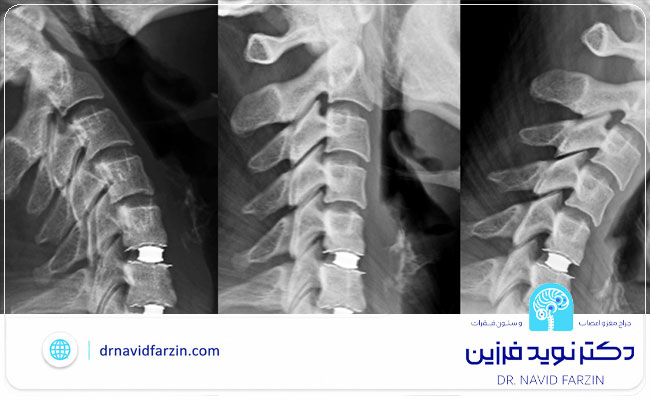 جراحی دیسک گردن در شیراز