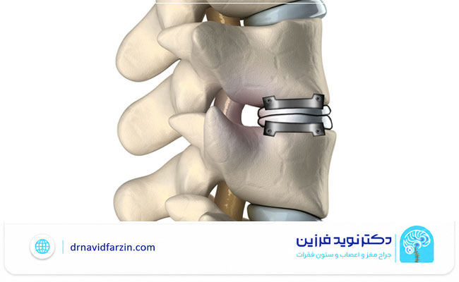 روش‌های جراحی دیسک گردن