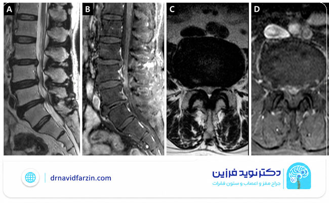 تشخیص تنگی نخاع با MRI و معاینه