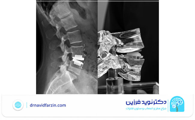 دیسک گردن چیست و چه علائمی ایجاد می‌کند؟