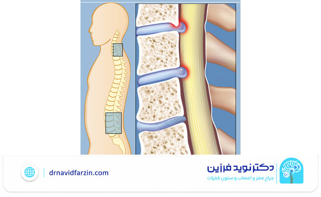علائم تنگی نخاع