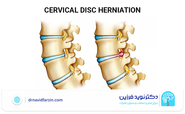 چه زمانی دیسک گردن نیاز به جراحی دارد؟