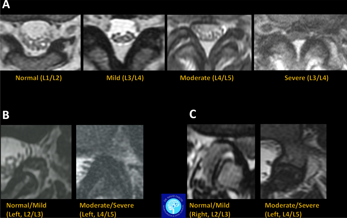 شدت تنگی در MRI مشخص می‌کند