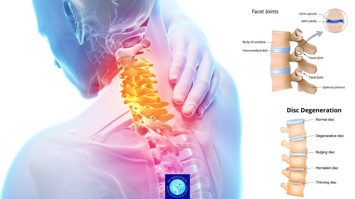 تفاوت دیسک گردن با گرفتگی عضلات چیست؟