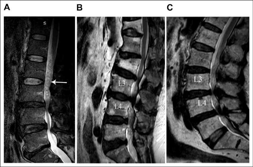 MRI چه نقشی در درمان تنگی نخاع دارد؟